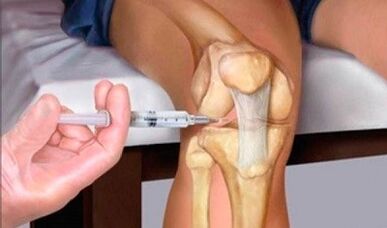 Hyaluronic acid with arthrosis of knee joint