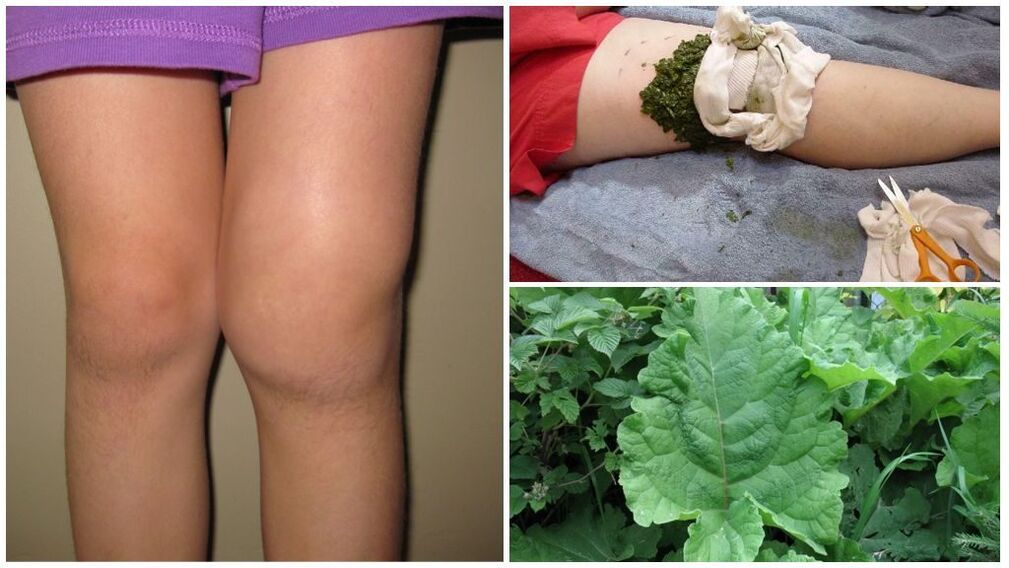 Knee compress with burdock - a folk method for the treatment of gonarthrosis