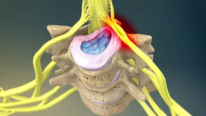 A herniated intervertebral disc causes neck pain