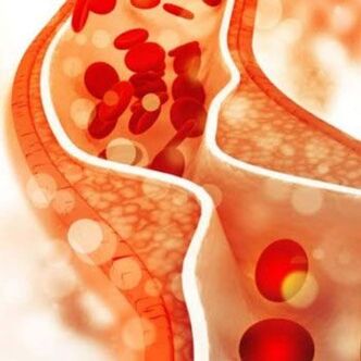 Cholesterol deposition on the inner walls of blood vessels causes neck pain.